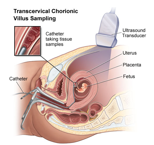 Chorionic Villus Sampling CVS Test