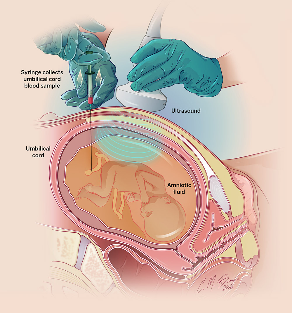 Cordocentesis PUBS Prenatal Diagnostic Procedure