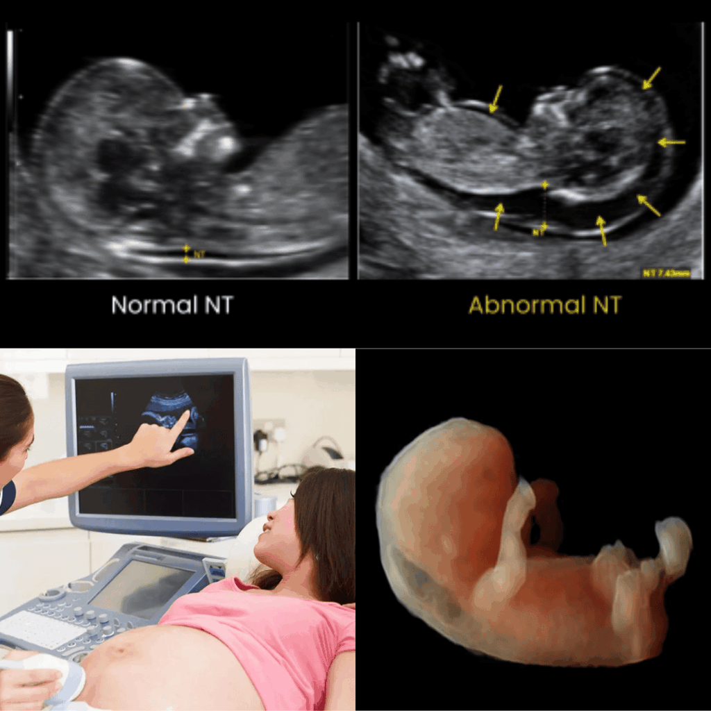 NT NB Scan Pregnancy Ultrasound